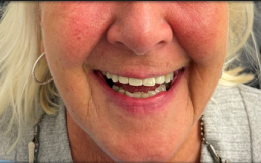 Case 2 Suneil after photo UPPER IMPLANT BRIDGE