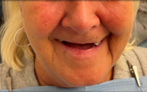 Case 2 Suneil before photo UPPER IMPLANT BRIDGE