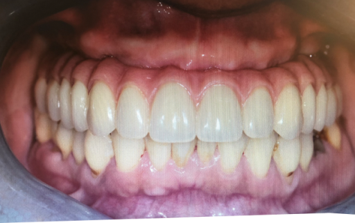 Case 5 Suneil after photo UPPER ALL ON 6